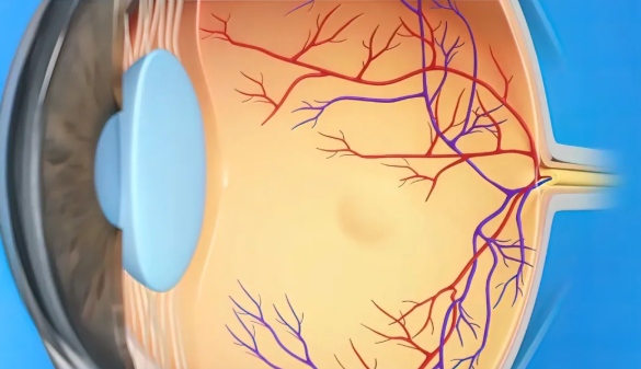 糖尿病視網(wǎng)膜病變