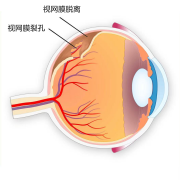 揉眼睛時出現(xiàn)閃光感是怎么回事？注意！可能是視網(wǎng)膜脫離！